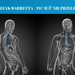 Przełyk Barretta to stan, w którym komórki wyściełające przełyk ulegają zmianom. Grafika pokazuje anatomię przełyku.