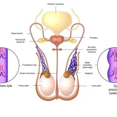Anatomia męskiego układu rozrodczego. Ilustracja pokazuje jądra, nasieniowody, pęcherz moczowy i prostatę. Po lewej stronie widok prawidłowej żyły, po prawej poszerzonej, co może być związane z nowotworem jądra.