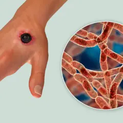Dłoń z czarną martwicą, objawem skórnego wąglika, obok powiększony obraz bakterii Bacillus anthracis.