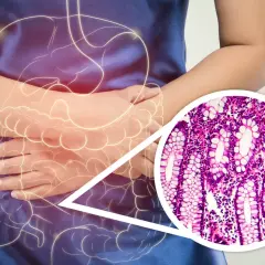 Osoba z bólem brzucha, podświetlony układ pokarmowy i zbliżenie na komórki jelita grubego, wskazujące na czerwonkę chorobę.