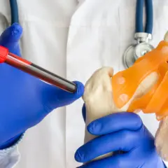 Lekarz w niebieskich rękawiczkach trzyma probówkę z krwią obok modelu miednicy, symbolizując diagnostykę raka szpiku kostnego.