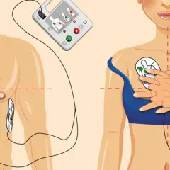 AED: Jak używać defibrylatora? Twoja prosta instrukcja ratunkowa.