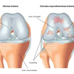 Porównanie zdrowego kolana z kolanem dotkniętym zwyrodnieniami stawów: uszkodzona chrząstka, odsłonięte kości, osteofity.