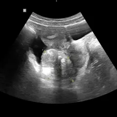 USG dopochwowe: obraz sugerujący raka jajnika z widocznymi wymiarami 5.28 cm i 3.79 cm.