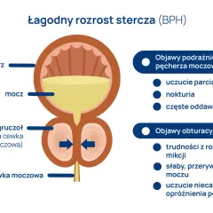 Ilustracja przedstawia łagodny przerost gruczołu krokowego (BPH), uciskającego cewkę moczową, co prowadzi do objawów podrażnienia i obturacji pęcherza.