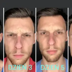 Mężczyzna pokazuje zmiany na twarzy po 7 dniach stosowania Denofix. Widać redukcję zmarszczek na czole i wokół oczu.