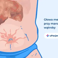 Ilustracja przedstawia brzuch z widoczną, uszkodzoną wątrobą i pajęczakiem naczyniowym. To objawy, które mogą świadczyć o tym, że wyleczyłem marskość wątroby.