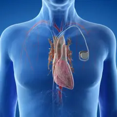 Jak działa kardiowerter-defibrylator (ICD)? Pełny przewodnik