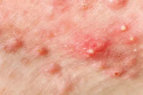 Skóra z widocznymi zmianami zapalnymi, ropnymi krostkami i zaczerwienieniem, charakterystycznymi dla hidradenitis suppurativa.