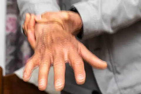 Dłoń z drżeniem, objawem sugerującym parkinsonizm.