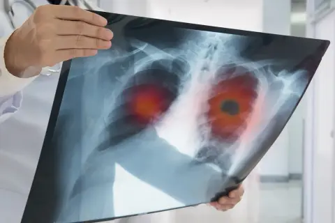 Lekarz analizuje RTG klatki piersiowej z widocznymi zmianami sugerującymi nieoperacyjnego raka płuc. Rokowania są trudne.
