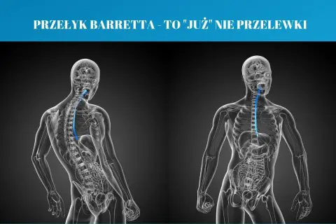 Przełyk Barretta to stan, w którym komórki wyściełające przełyk ulegają zmianom. Grafika pokazuje anatomię przełyku.