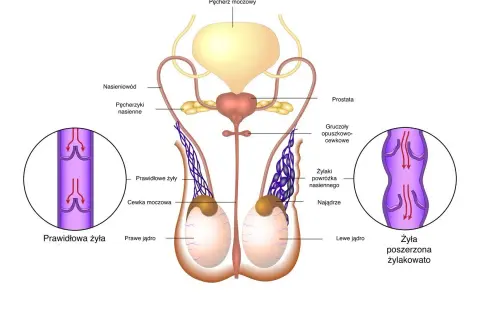 Anatomia męskiego układu rozrodczego. Ilustracja pokazuje jądra, nasieniowody, pęcherz moczowy i prostatę. Po lewej stronie widok prawidłowej żyły, po prawej poszerzonej, co może być związane z nowotworem jądra.