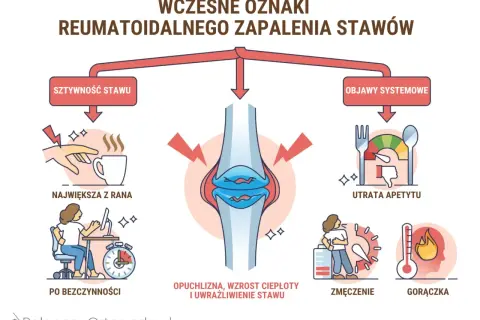 Wczesne oznaki reumatoidalnego zapalenia stawów: sztywność, opuchlizna, zmęczenie, gorączka, utrata apetytu. Stan zapalny w organizmie objawia się na różne sposoby.