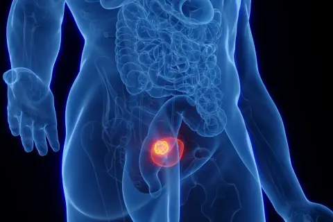 Anatomical illustration showing a tumor within the bladder, symbolizing the progression of umieranie na raka pęcherza.