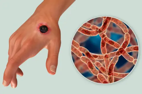 Dłoń z czarną martwicą, objawem skórnego wąglika, obok powiększony obraz bakterii Bacillus anthracis.