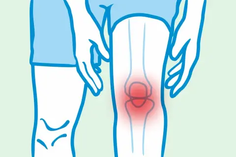 Ilustracja przedstawia ból kolana, który może być objawem spondyloartropatii. Rokowanie zależy od wczesnej diagnozy i leczenia.