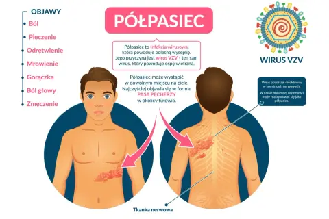 Półpasiec to wirusowa choroba wywołana przez wirus VZV, ten sam co ospa. Reaktywuje się przy obniżonej odporności, objawiając się bólem i pęcherzami.