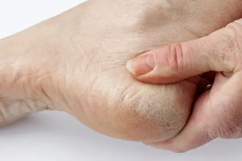 Suchy, popękany naskórek na pięcie, przypominający rogowiec krwawy, jest masowany palcami.