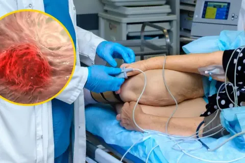Lekarz w rękawiczkach przygotowuje pacjenta do zabiegu, podczas gdy powiększony obraz pokazuje niebezpieczny gruczolak jelita grubego.