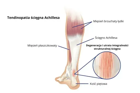 Anatomia łydki z zaznaczonym ścięgnem Achillesa, mięśniami i kością piętową. Ilustracja pokazuje degenerację ścięgna, która może powodować ból nog.