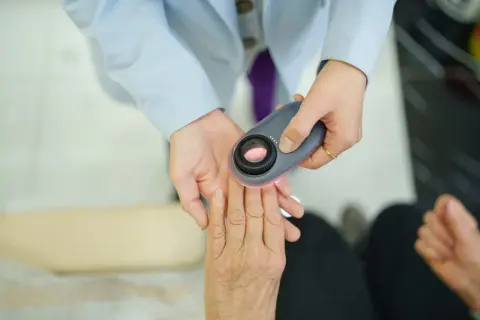 Lekarz w błękitnej **ropie** bada dłoń pacjenta dermatoskopem.