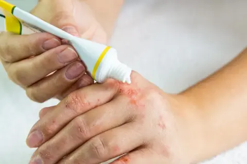 Osoba aplikuje maść salbetan na suchą, zaczerwienioną skórę dłoni.