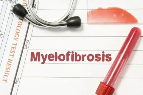 Wyniki badań hematologicznych wskazują na mielofibrozę. Stetoskop i probówka z krwią dopełniają obraz diagnostyczny.