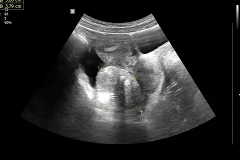USG dopochwowe: obraz sugerujący raka jajnika z widocznymi wymiarami 5.28 cm i 3.79 cm.