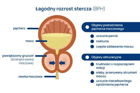 Ilustracja przedstawia łagodny przerost gruczołu krokowego (BPH), uciskającego cewkę moczową, co prowadzi do objawów podrażnienia i obturacji pęcherza.