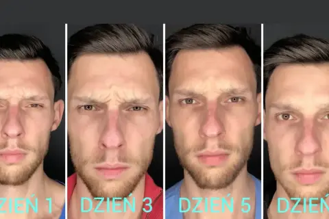 Mężczyzna pokazuje zmiany na twarzy po 7 dniach stosowania Denofix. Widać redukcję zmarszczek na czole i wokół oczu.