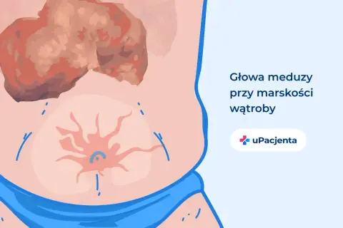 Ilustracja przedstawia brzuch z widoczną, uszkodzoną wątrobą i pajęczakiem naczyniowym. To objawy, które mogą świadczyć o tym, że wyleczyłem marskość wątroby.