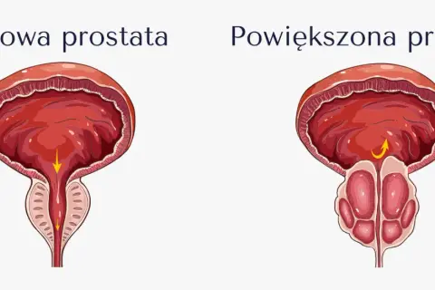 Porównanie zdrowej i powiększonej prostaty. Nowoczesne leki na prostatę pomagają przywrócić prawidłowy przepływ.
