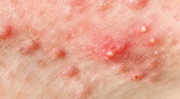 Skóra z widocznymi zmianami zapalnymi, ropnymi krostkami i zaczerwienieniem, charakterystycznymi dla hidradenitis suppurativa.