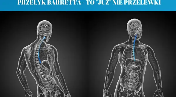 Przełyk Barretta to stan, w którym komórki wyściełające przełyk ulegają zmianom. Grafika pokazuje anatomię przełyku.