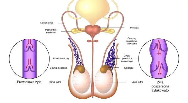 Anatomia męskiego układu rozrodczego. Ilustracja pokazuje jądra, nasieniowody, pęcherz moczowy i prostatę. Po lewej stronie widok prawidłowej żyły, po prawej poszerzonej, co może być związane z nowotworem jądra.