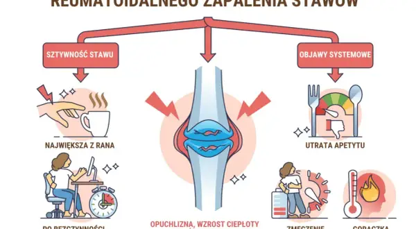 Wczesne oznaki reumatoidalnego zapalenia stawów: sztywność, opuchlizna, zmęczenie, gorączka, utrata apetytu. Stan zapalny w organizmie objawia się na różne sposoby.