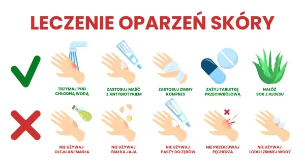 Porady dotyczące leczenia oparzeń skóry: chłodna woda, maść z antybiotykiem, zimny kompres, tabletki przeciwbólowe, sok z aloesu. Unikaj masła, jajka, pasty do zębów, przekłuwania pęcherzy, lodu.