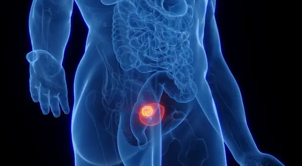 Anatomical illustration showing a tumor within the bladder, symbolizing the progression of umieranie na raka pęcherza.