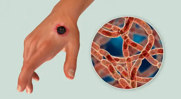 Dłoń z czarną martwicą, objawem skórnego wąglika, obok powiększony obraz bakterii Bacillus anthracis.