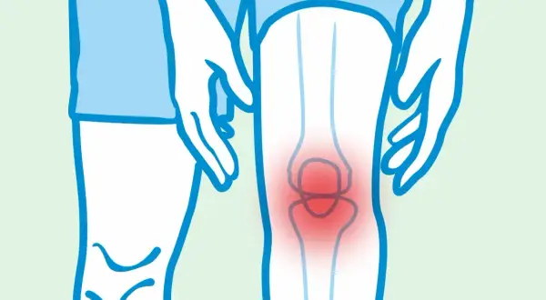 Ilustracja przedstawia ból kolana, który może być objawem spondyloartropatii. Rokowanie zależy od wczesnej diagnozy i leczenia.