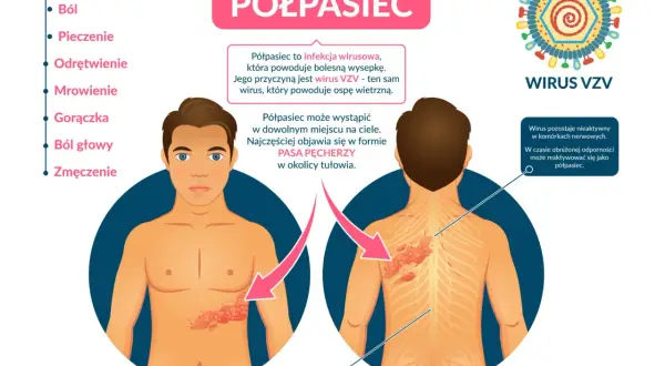 Półpasiec to wirusowa choroba wywołana przez wirus VZV, ten sam co ospa. Reaktywuje się przy obniżonej odporności, objawiając się bólem i pęcherzami.