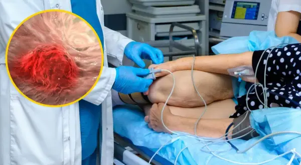 Lekarz w rękawiczkach przygotowuje pacjenta do zabiegu, podczas gdy powiększony obraz pokazuje niebezpieczny gruczolak jelita grubego.