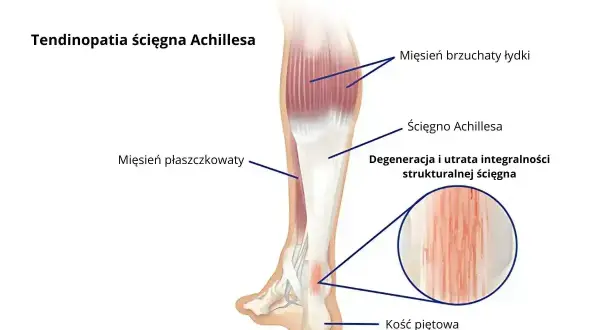 Anatomia łydki z zaznaczonym ścięgnem Achillesa, mięśniami i kością piętową. Ilustracja pokazuje degenerację ścięgna, która może powodować ból nog.