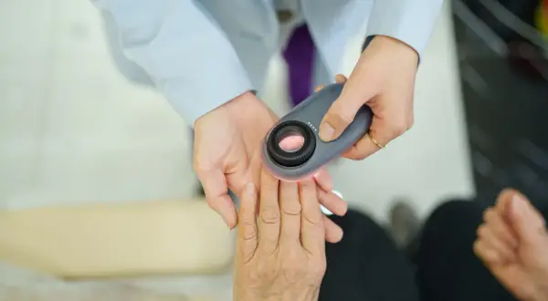 Lekarz w błękitnej **ropie** bada dłoń pacjenta dermatoskopem.
