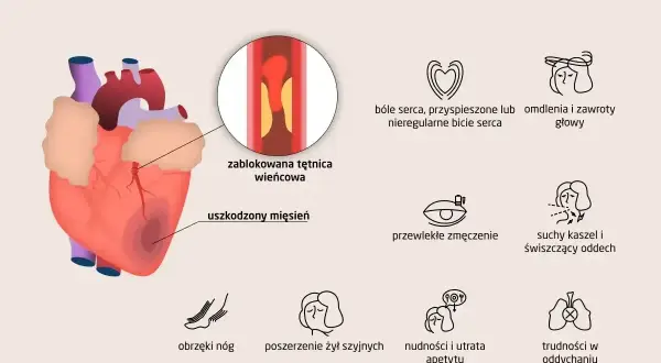 Objawy niewydolności serca: ból serca, omdlenia, zmęczenie, obrzęki nóg, nudności, trudności w oddychaniu i suchy kaszel, który może być objawem kaszlu od serca.