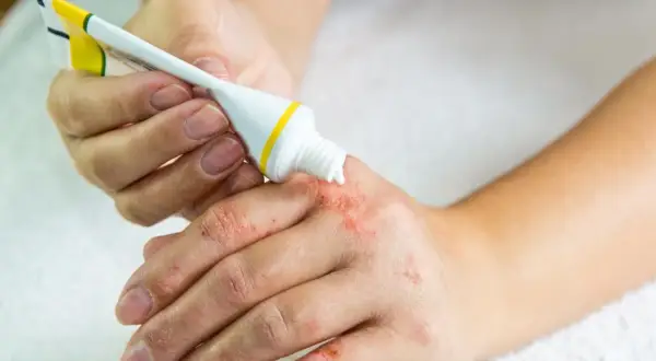 Osoba aplikuje maść salbetan na suchą, zaczerwienioną skórę dłoni.