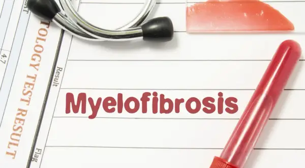 Wyniki badań hematologicznych wskazują na mielofibrozę. Stetoskop i probówka z krwią dopełniają obraz diagnostyczny.