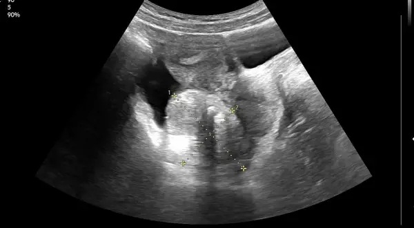 USG dopochwowe: obraz sugerujący raka jajnika z widocznymi wymiarami 5.28 cm i 3.79 cm.
