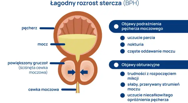 Ilustracja przedstawia łagodny przerost gruczołu krokowego (BPH), uciskającego cewkę moczową, co prowadzi do objawów podrażnienia i obturacji pęcherza.